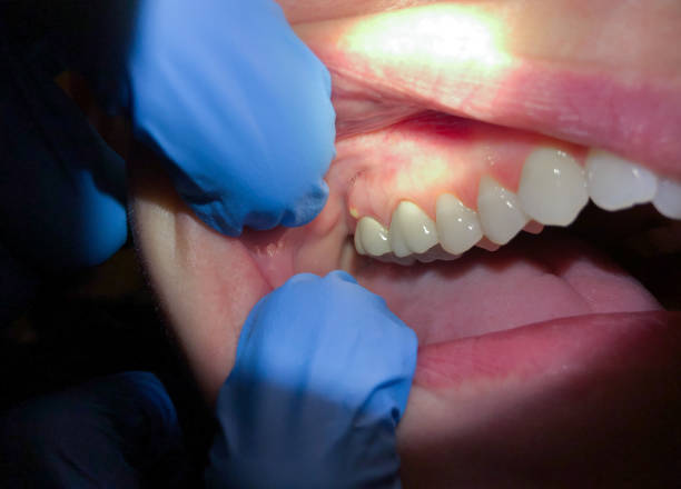 Best Tooth Infection Emergency Dentist  in North Puyallup, WA