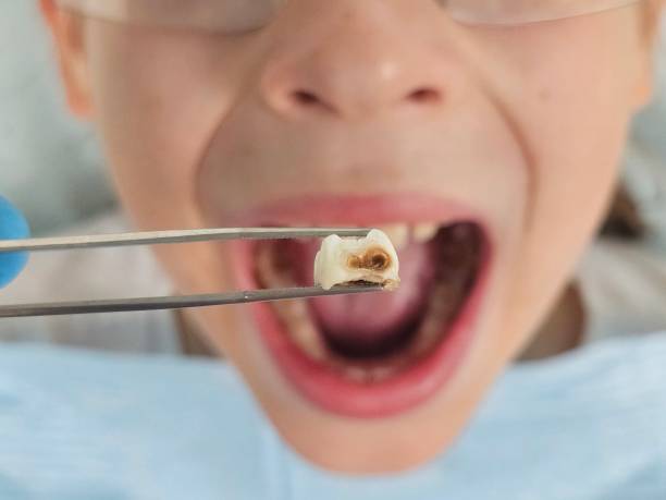 Best Broken Tooth Emergency  in North Puyallup, WA